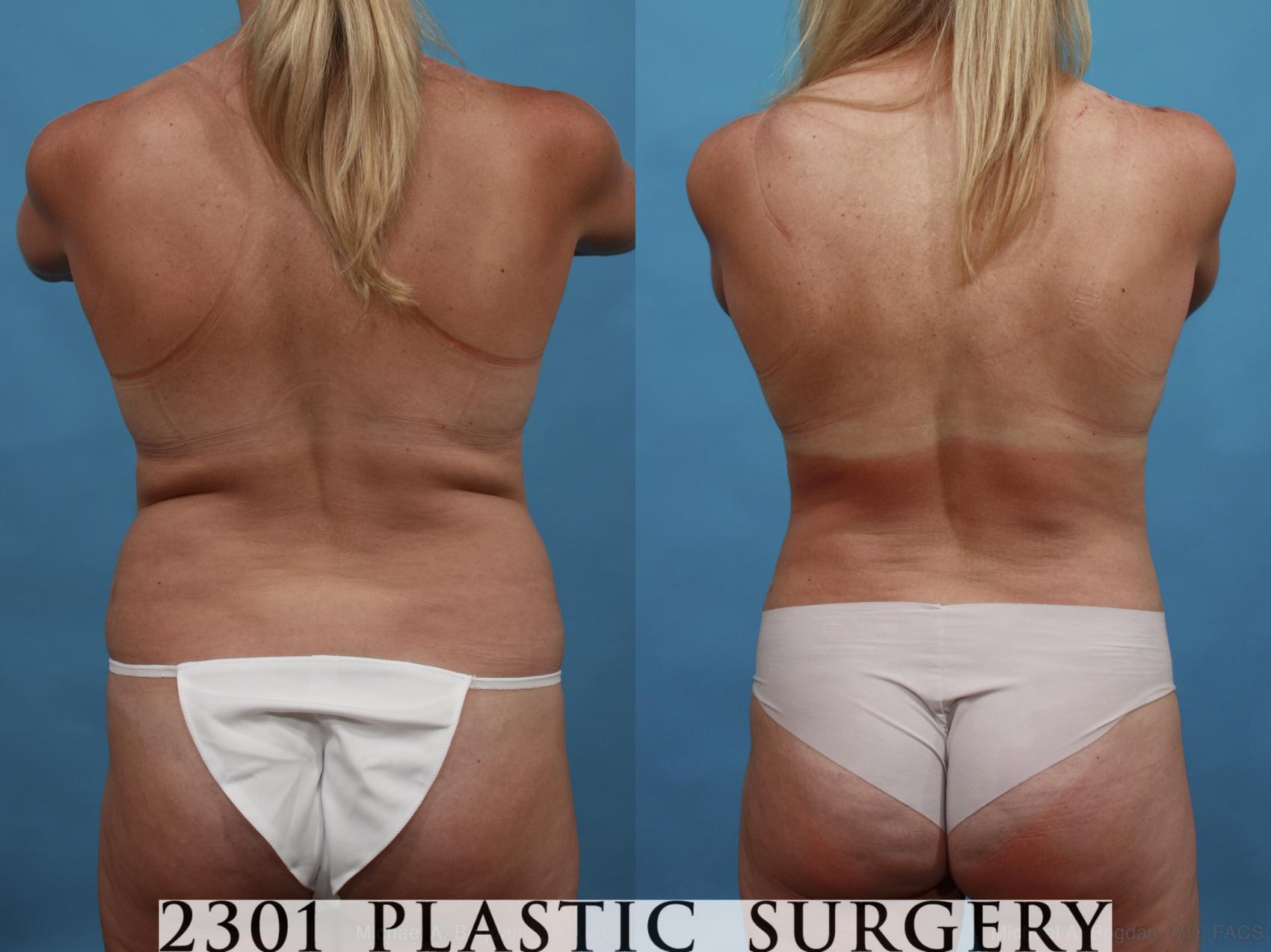 Before & After Mommy Makeover Case 547 View #6 View in Fort Worth & Frisco, Texas