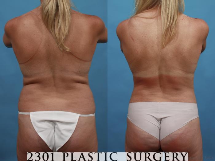 Before & After Mommy Makeover Case 547 View #6 View in Fort Worth, Plano, & Frisco, Texas