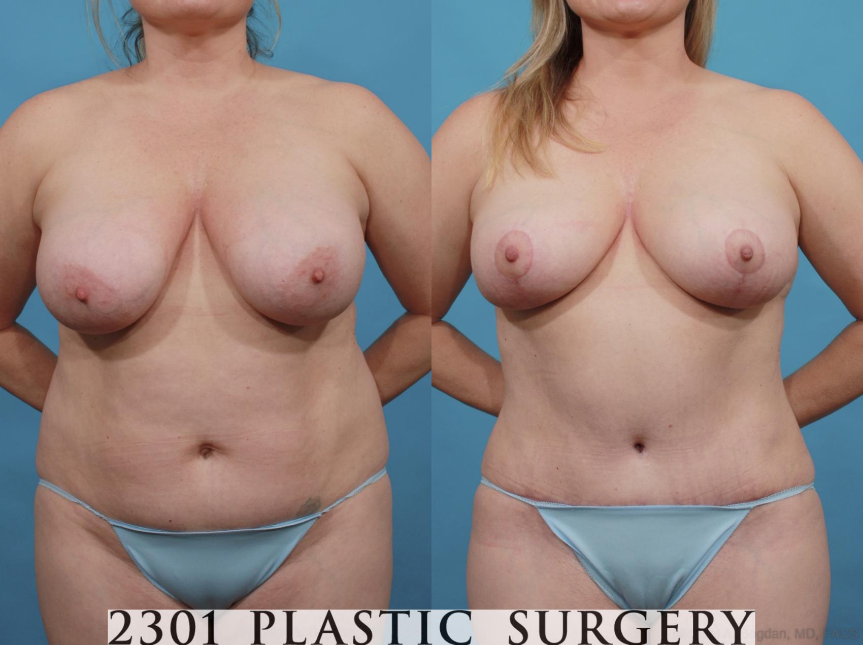Before & After Mommy Makeover Case 549 View #1 View in Fort Worth & Frisco, Texas