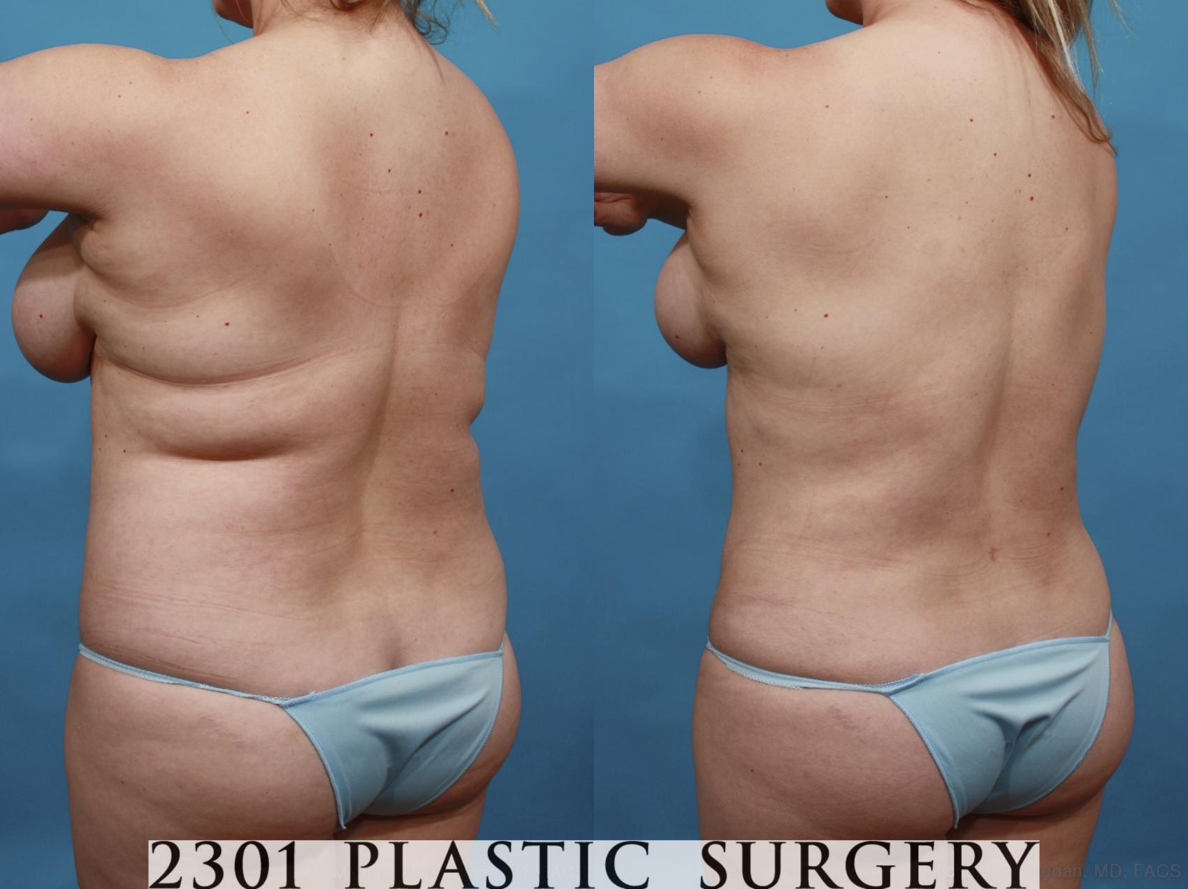 Before & After Mommy Makeover Case 549 View #5 View in Fort Worth & Frisco, Texas