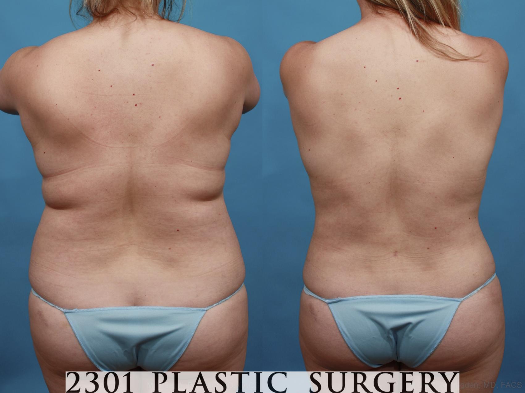 Before & After Mommy Makeover Case 549 View #6 View in Fort Worth & Frisco, Texas