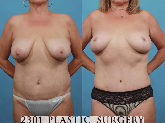 Before & After Mommy Makeover Case 552 View #1 View in Fort Worth, Plano, & Frisco, Texas