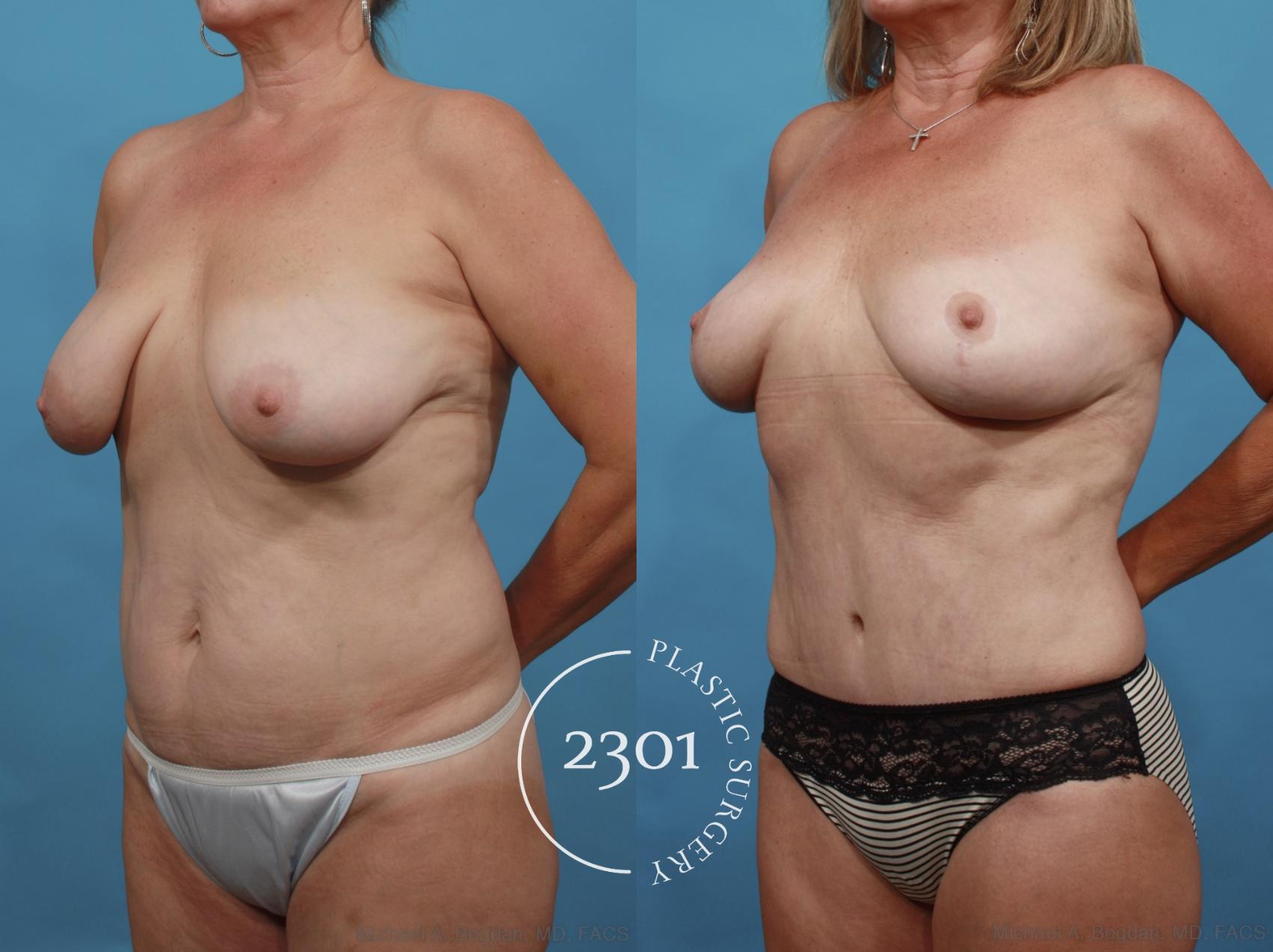 Before & After Tummy Tuck Case 552 View #2 View in Fort Worth, Plano, & Frisco, Texas