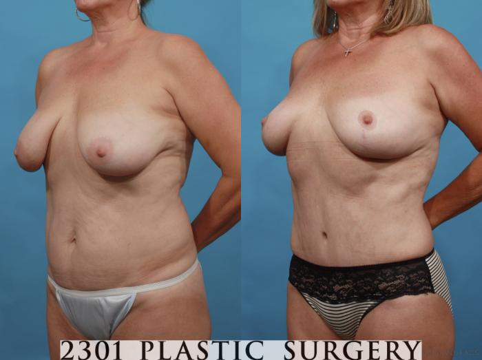 Before & After Tummy Tuck Case 552 View #2 View in Fort Worth, Plano, & Frisco, Texas