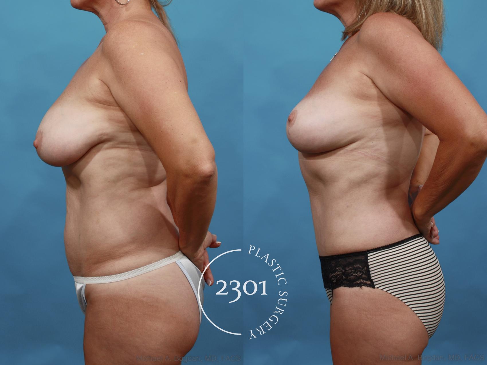 Before & After Tummy Tuck Case 552 View #3 View in Fort Worth, Plano, & Frisco, Texas