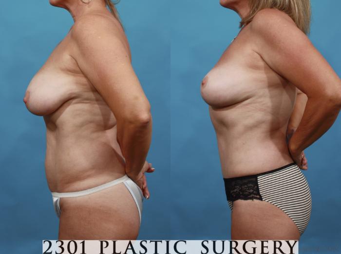 Before & After Mommy Makeover Case 552 View #3 View in Fort Worth, Plano, & Frisco, Texas