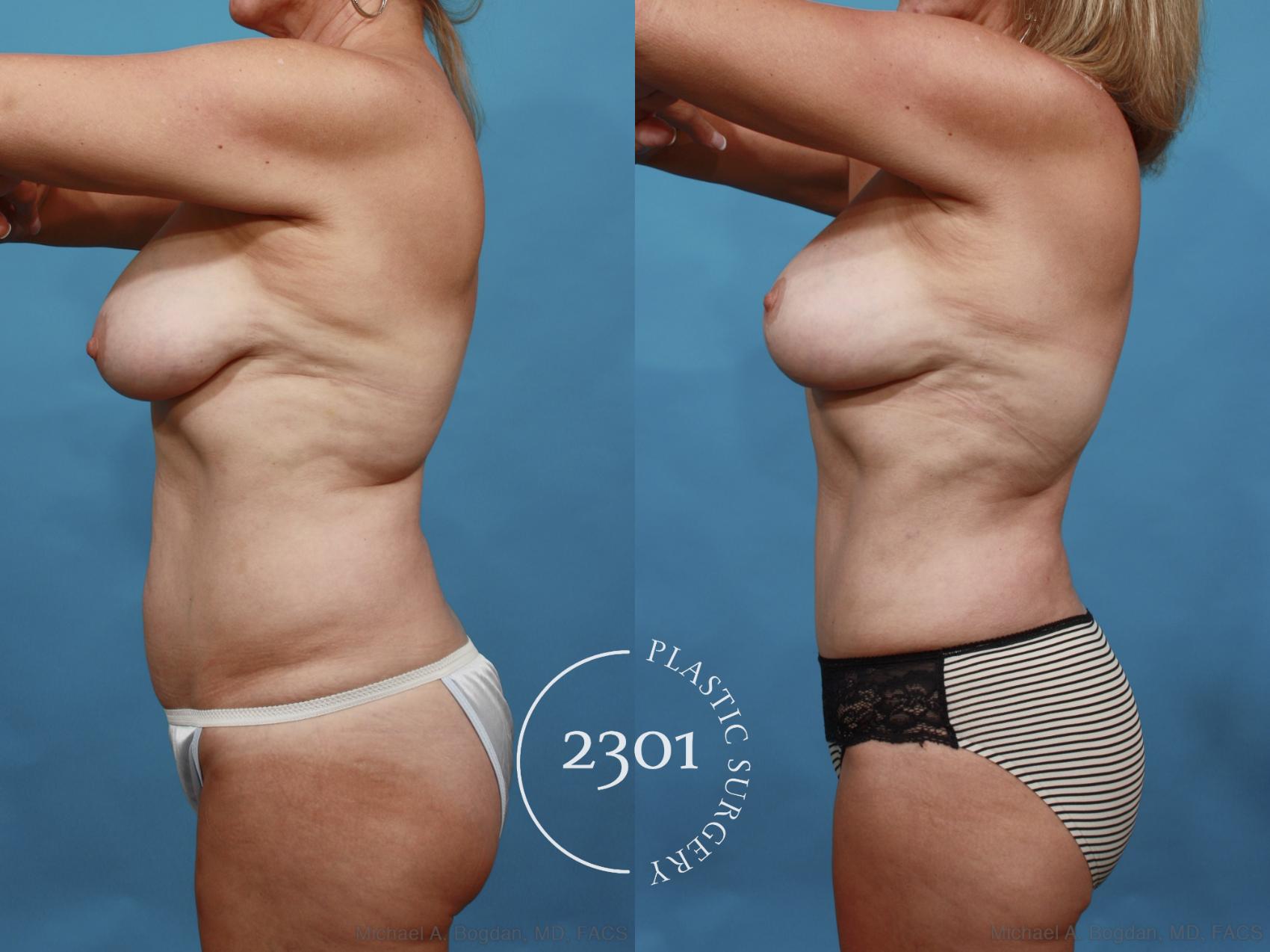 Before & After Tummy Tuck Case 552 View #4 View in Fort Worth, Plano, & Frisco, Texas