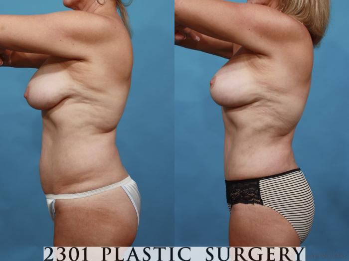 Before & After Breast Lift (Mastopexy) Case 552 View #4 View in Fort Worth, Plano, & Frisco, Texas