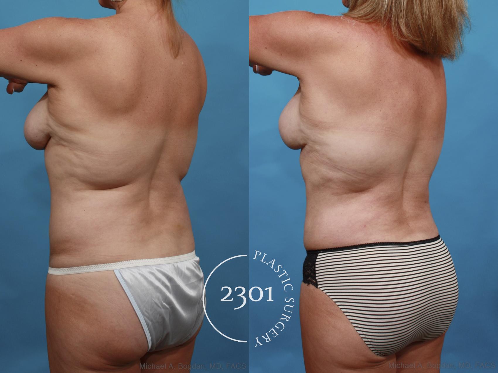 Before & After Tummy Tuck Case 552 View #5 View in Fort Worth, Plano, & Frisco, Texas