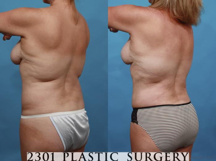 Before & After Breast Lift (Mastopexy) Case 552 View #5 View in Fort Worth, Plano, & Frisco, Texas