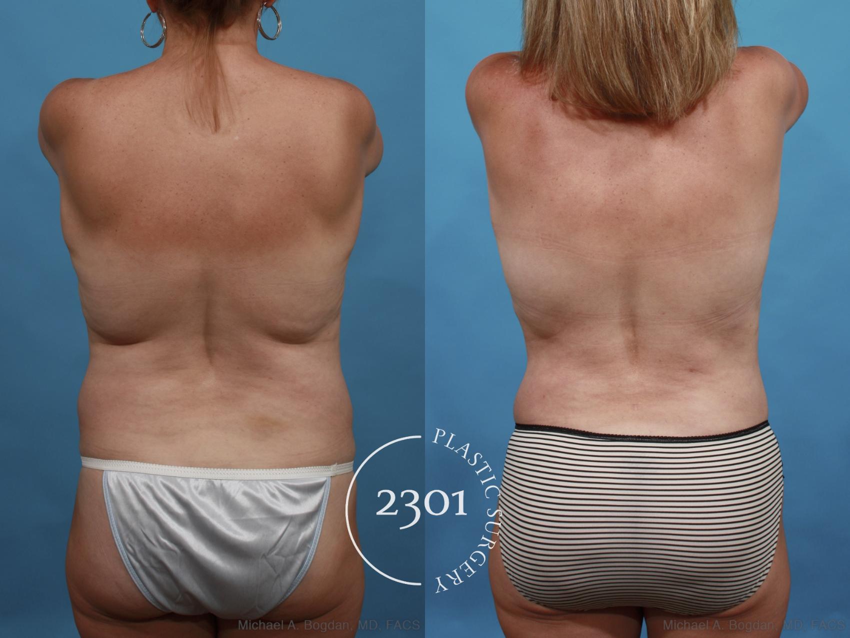 Before & After Tummy Tuck Case 552 View #6 View in Fort Worth, Plano, & Frisco, Texas