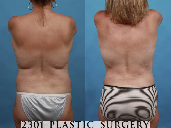 Before & After Breast Lift (Mastopexy) Case 552 View #6 View in Fort Worth, Plano, & Frisco, Texas