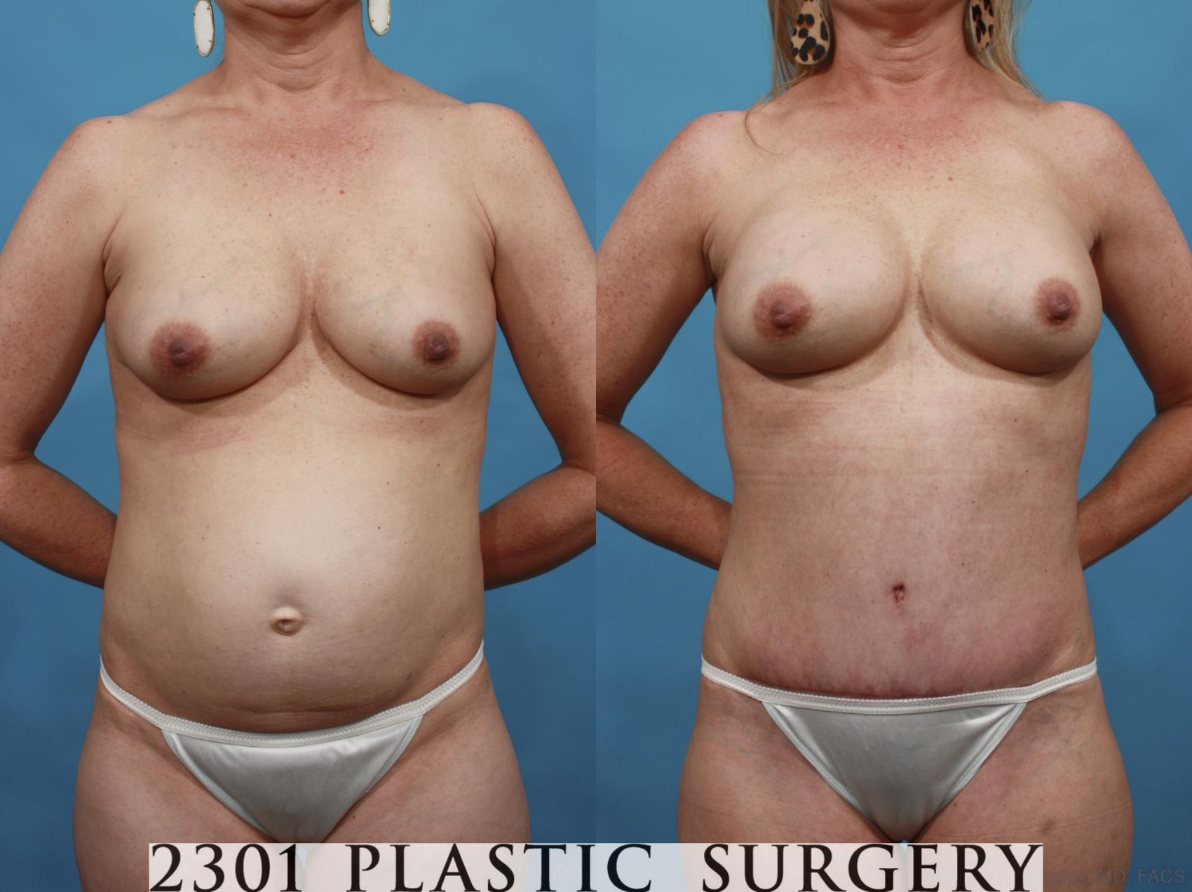 Before & After Mommy Makeover Case 553 View #1 View in Fort Worth & Frisco, Texas
