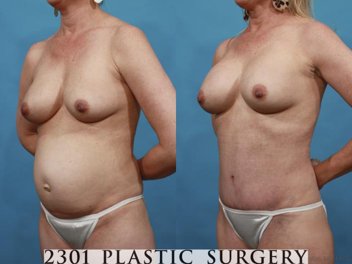 Before & After Mommy Makeover Case 553 View #2 View in Fort Worth, Plano, & Frisco, Texas