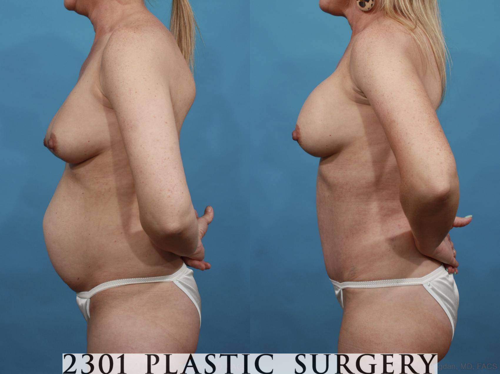 Before & After Mommy Makeover Case 553 View #3 View in Fort Worth & Frisco, Texas