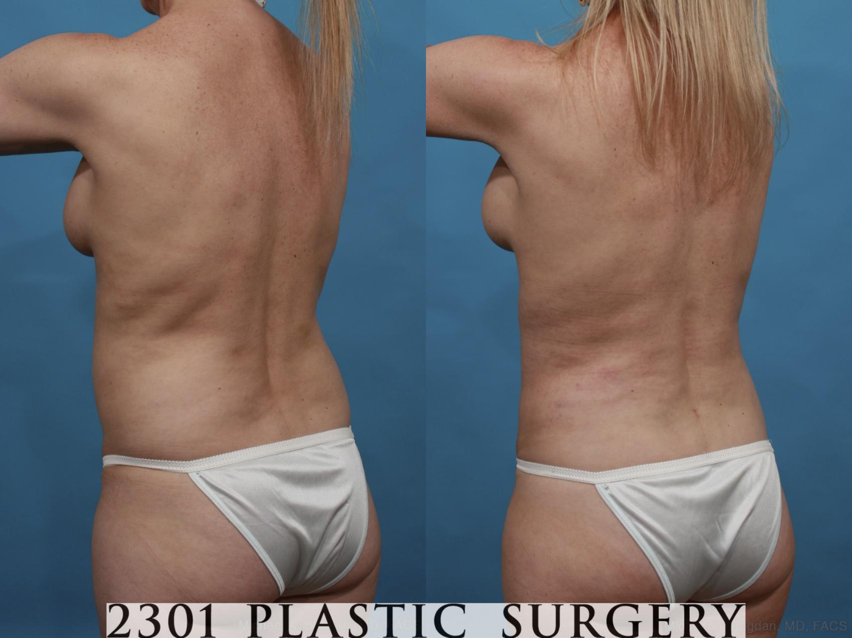 Before & After Mommy Makeover Case 553 View #4 View in Fort Worth & Frisco, Texas
