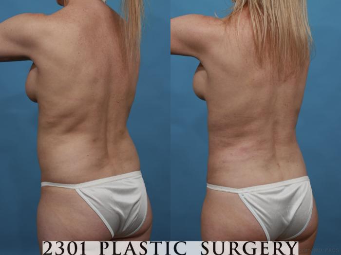 Before & After Mommy Makeover Case 553 View #4 View in Fort Worth, Plano, & Frisco, Texas
