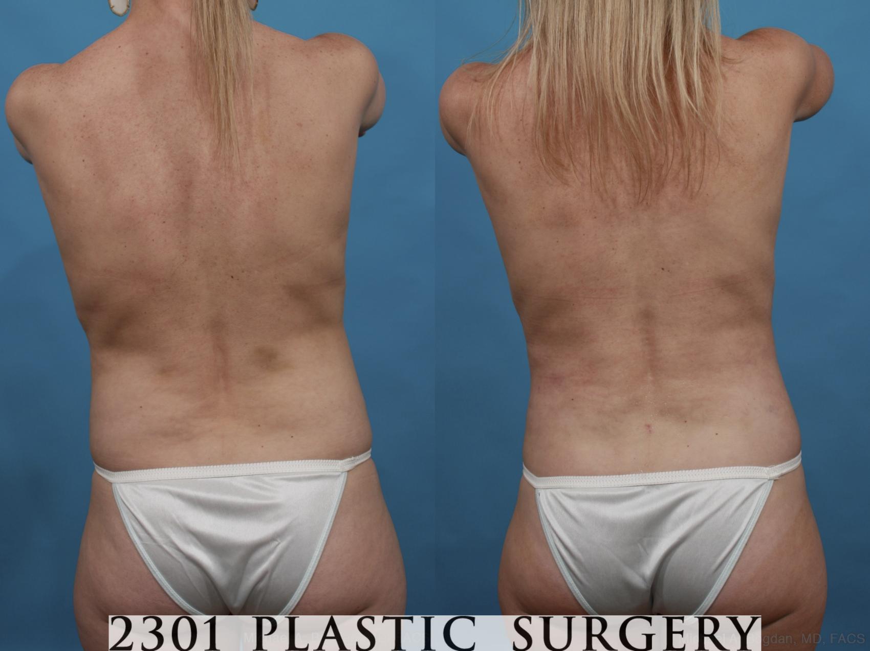 Before & After Mommy Makeover Case 553 View #5 View in Fort Worth & Frisco, Texas
