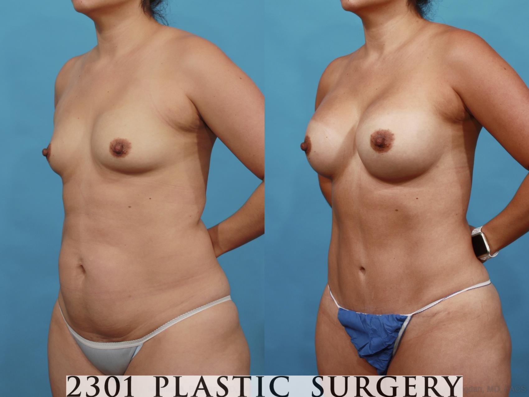 Before & After Mommy Makeover Case 554 View #2 View in Fort Worth & Frisco, Texas