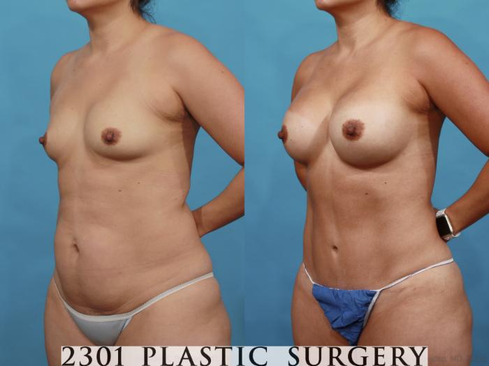 Before & After Mommy Makeover Case 554 View #2 View in Fort Worth, Plano, & Frisco, Texas