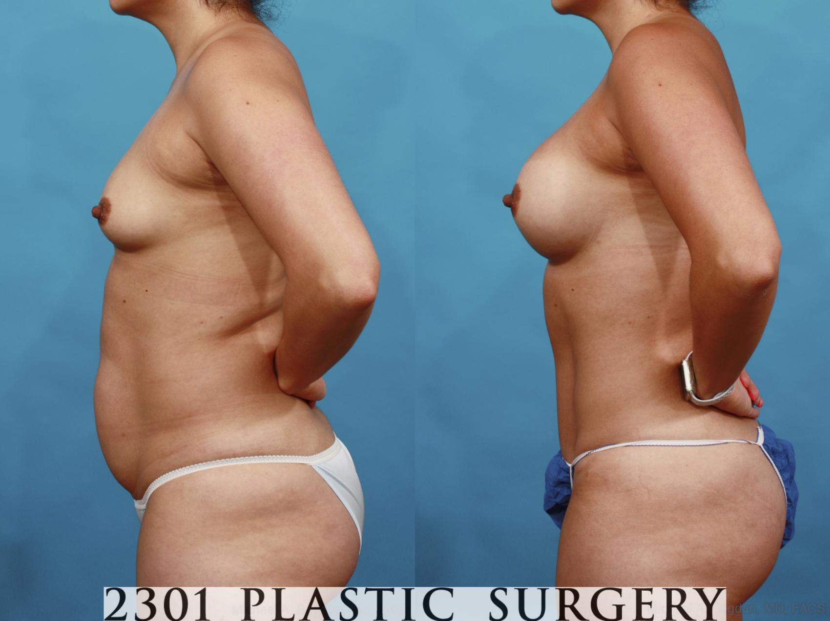 Before & After Mommy Makeover Case 554 View #3 View in Fort Worth & Frisco, Texas