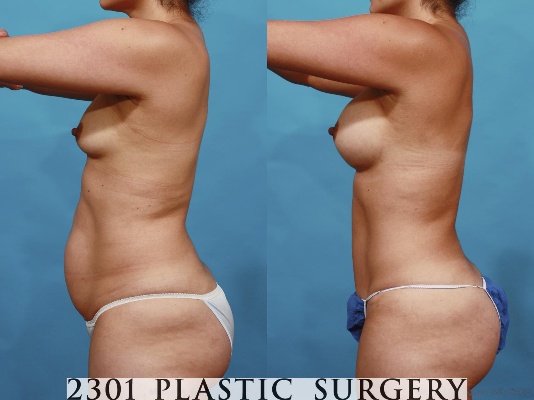 Before & After Mommy Makeover Case 554 View #4 View in Fort Worth & Frisco, Texas