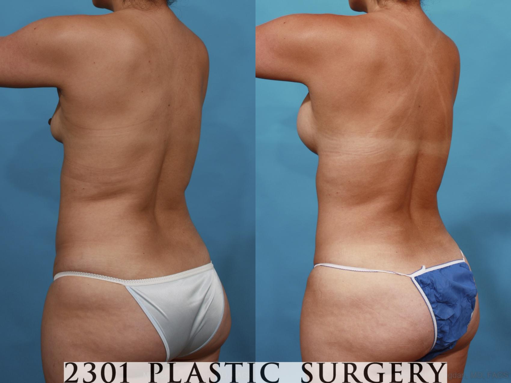 Before & After Mommy Makeover Case 554 View #5 View in Fort Worth & Frisco, Texas