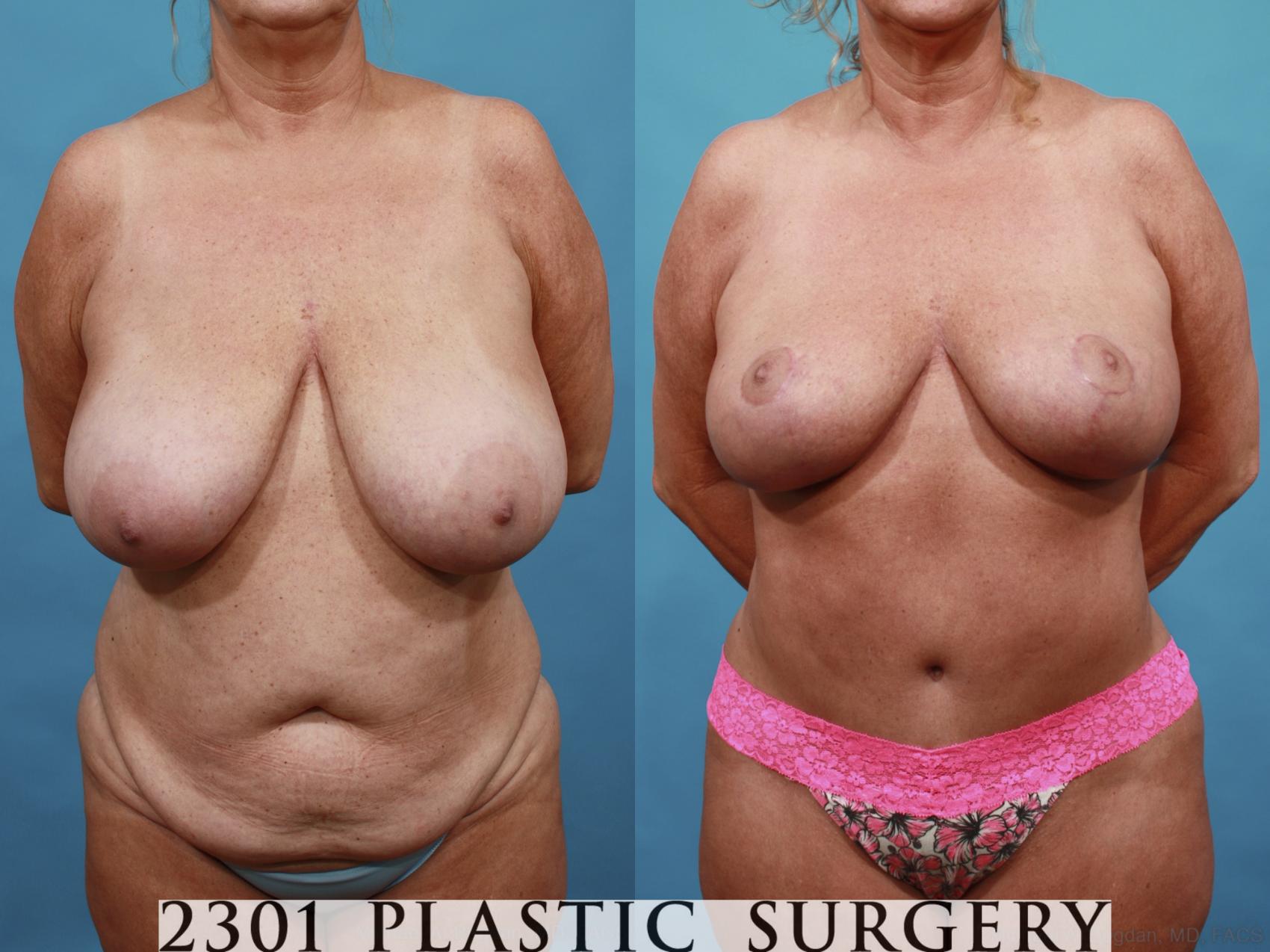 Before & After Breast Reduction Case 561 View #1 View in Fort Worth, Plano, & Frisco, Texas