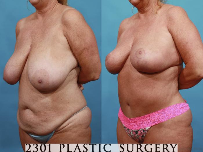 Before & After Breast Reduction Case 561 View #2 View in Fort Worth, Plano, & Frisco, Texas
