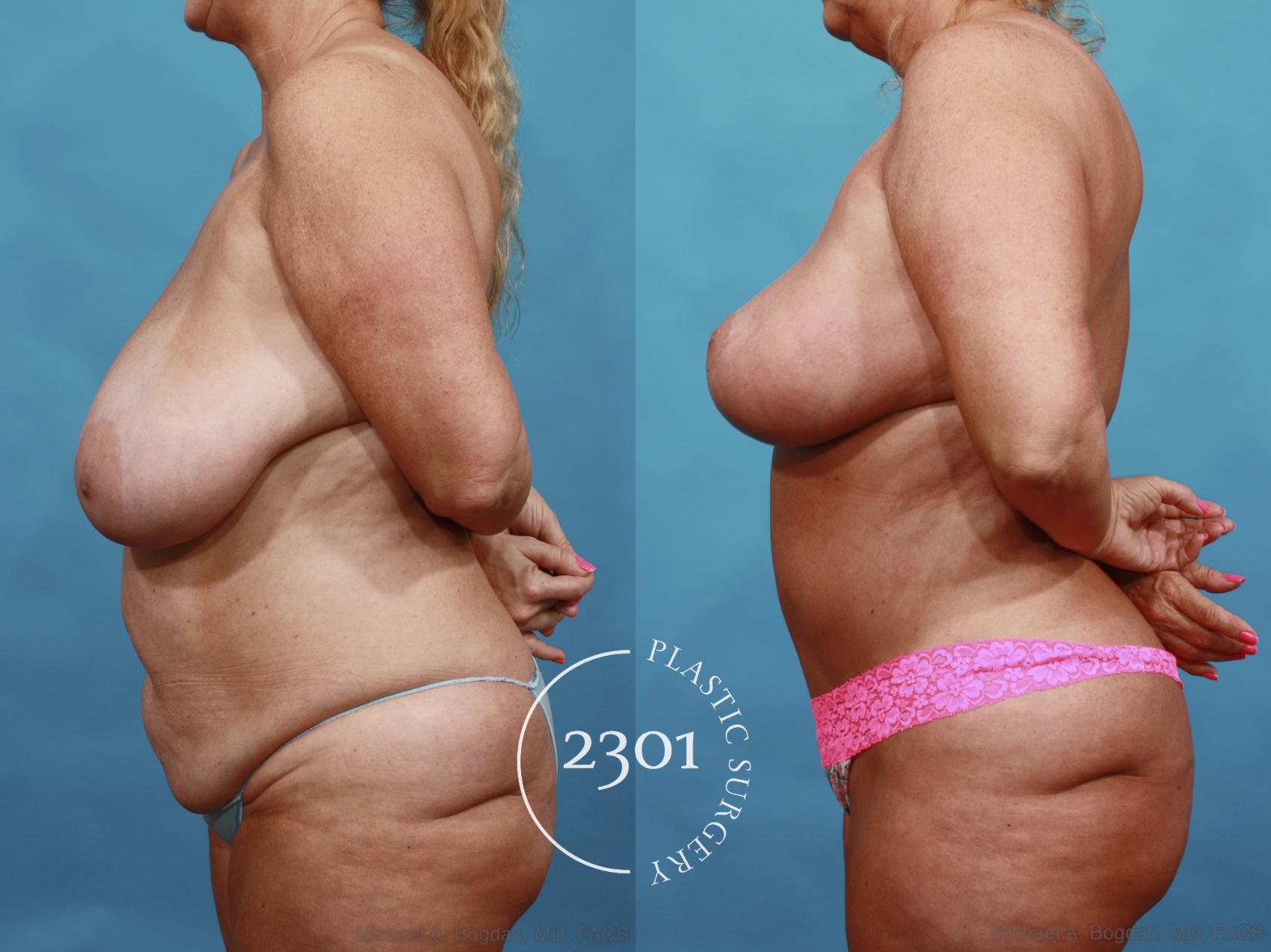 Before & After Mommy Makeover Case 561 View #3 View in Fort Worth, Plano, & Frisco, Texas