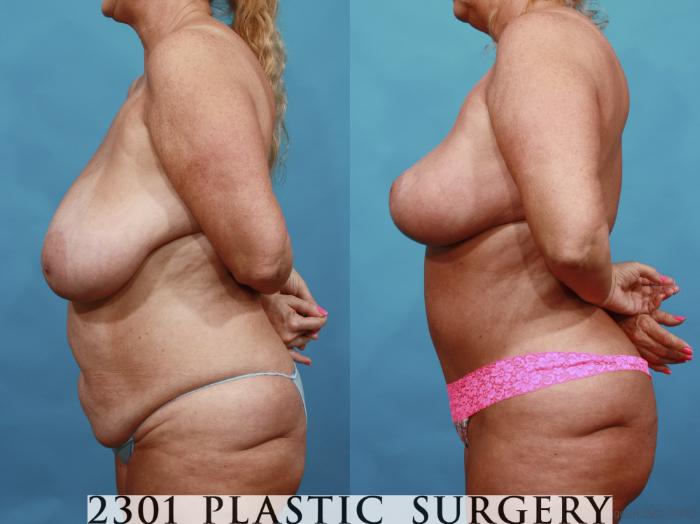 Before & After Breast Reduction Case 561 View #3 View in Fort Worth, Plano, & Frisco, Texas