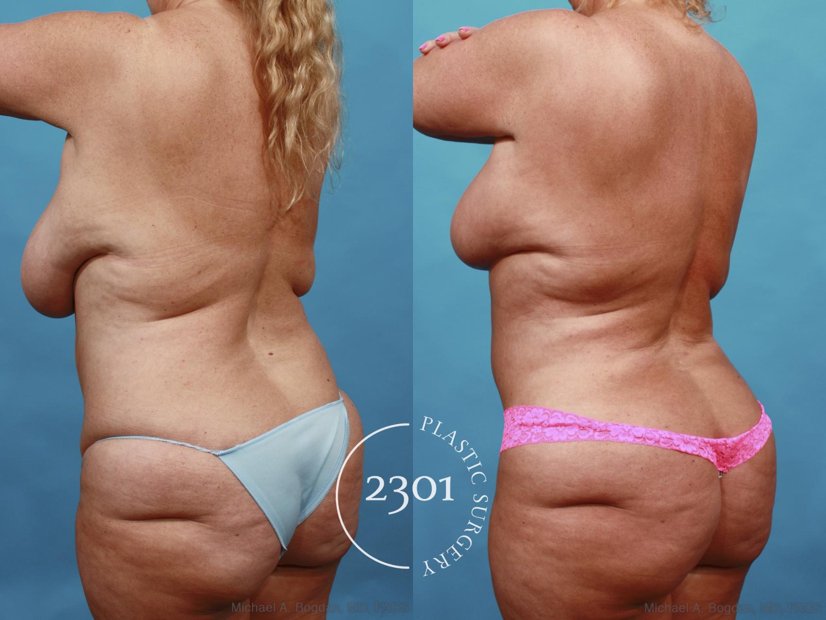 Before & After Mommy Makeover Case 561 View #4 View in Fort Worth, Plano, & Frisco, Texas