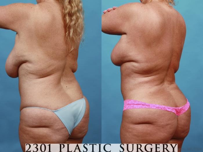 Before & After Breast Reduction Case 561 View #4 View in Fort Worth, Plano, & Frisco, Texas