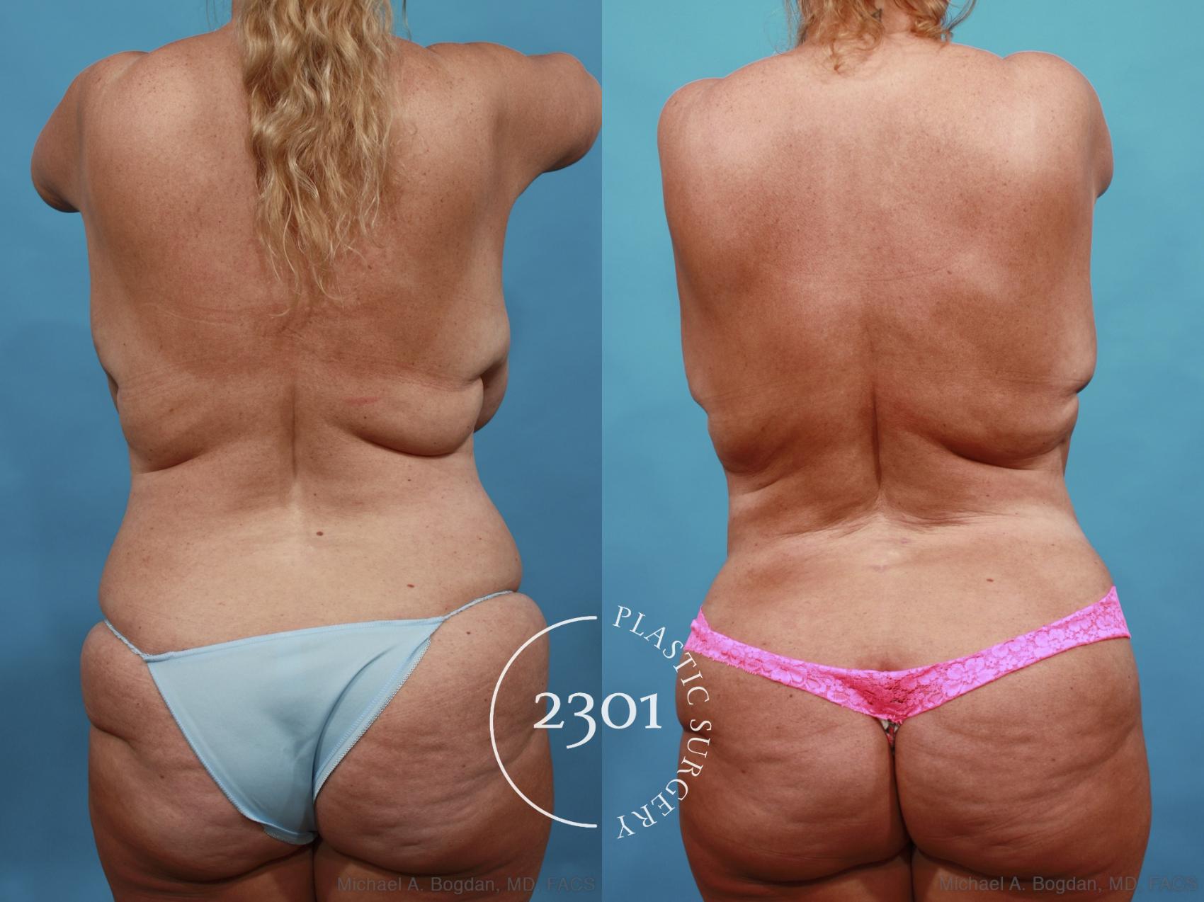Before & After Mommy Makeover Case 561 View #5 View in Fort Worth, Plano, & Frisco, Texas