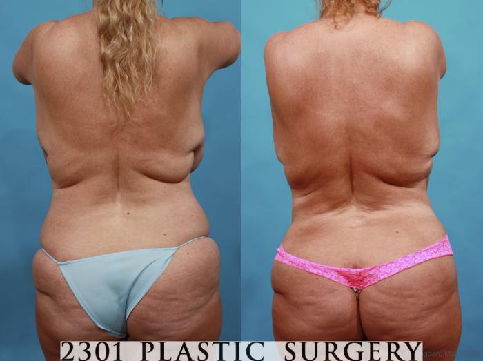Before & After Mommy Makeover Case 561 View #5 View in Fort Worth, Plano, & Frisco, Texas