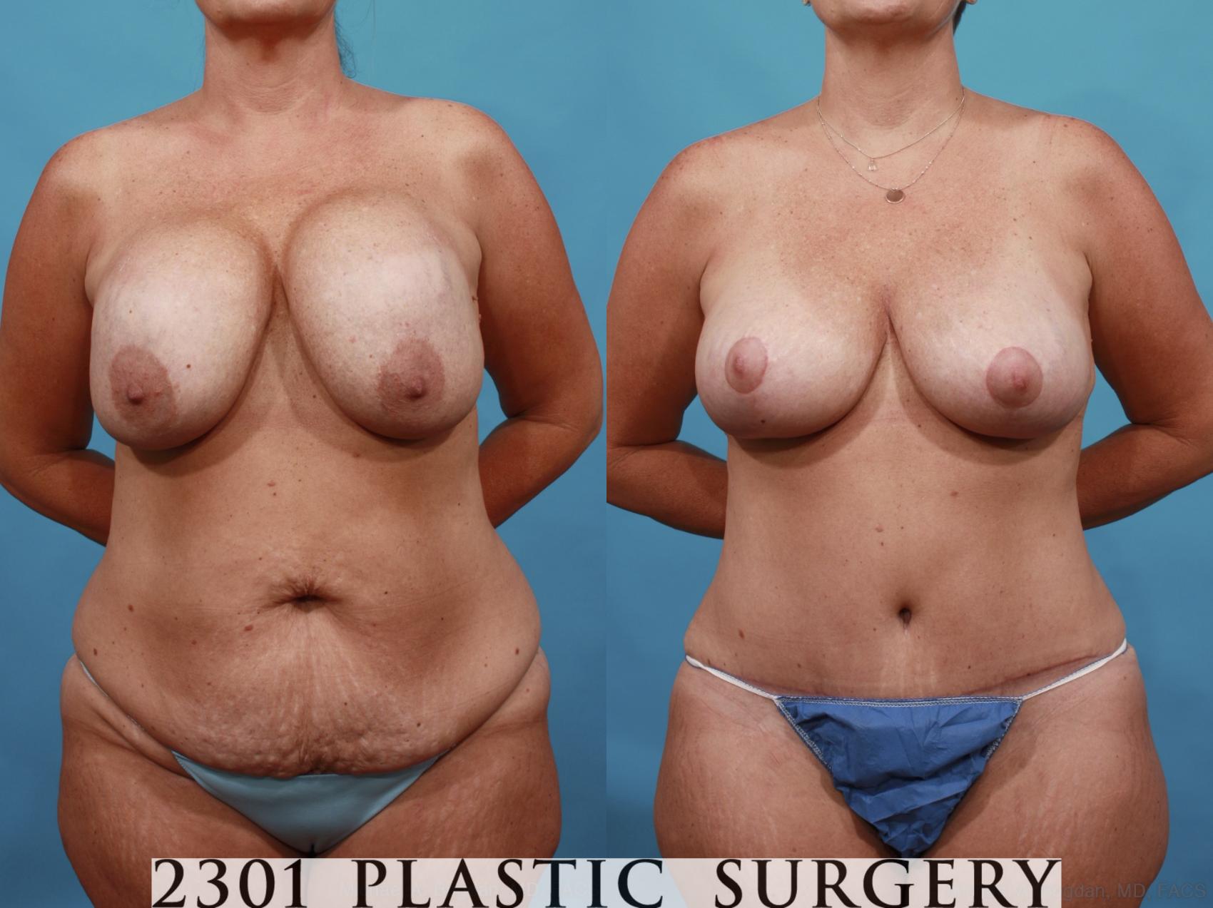 Before & After Breast Augmentation Revision Case 567 View #1 View in Fort Worth & Frisco, Texas