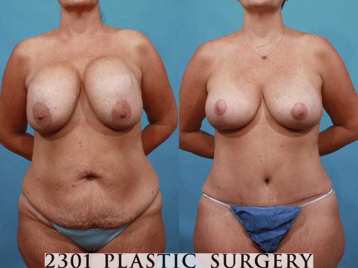 Before & After Breast Augmentation Revision Case 567 View #1 View in Fort Worth, Plano, & Frisco, Texas