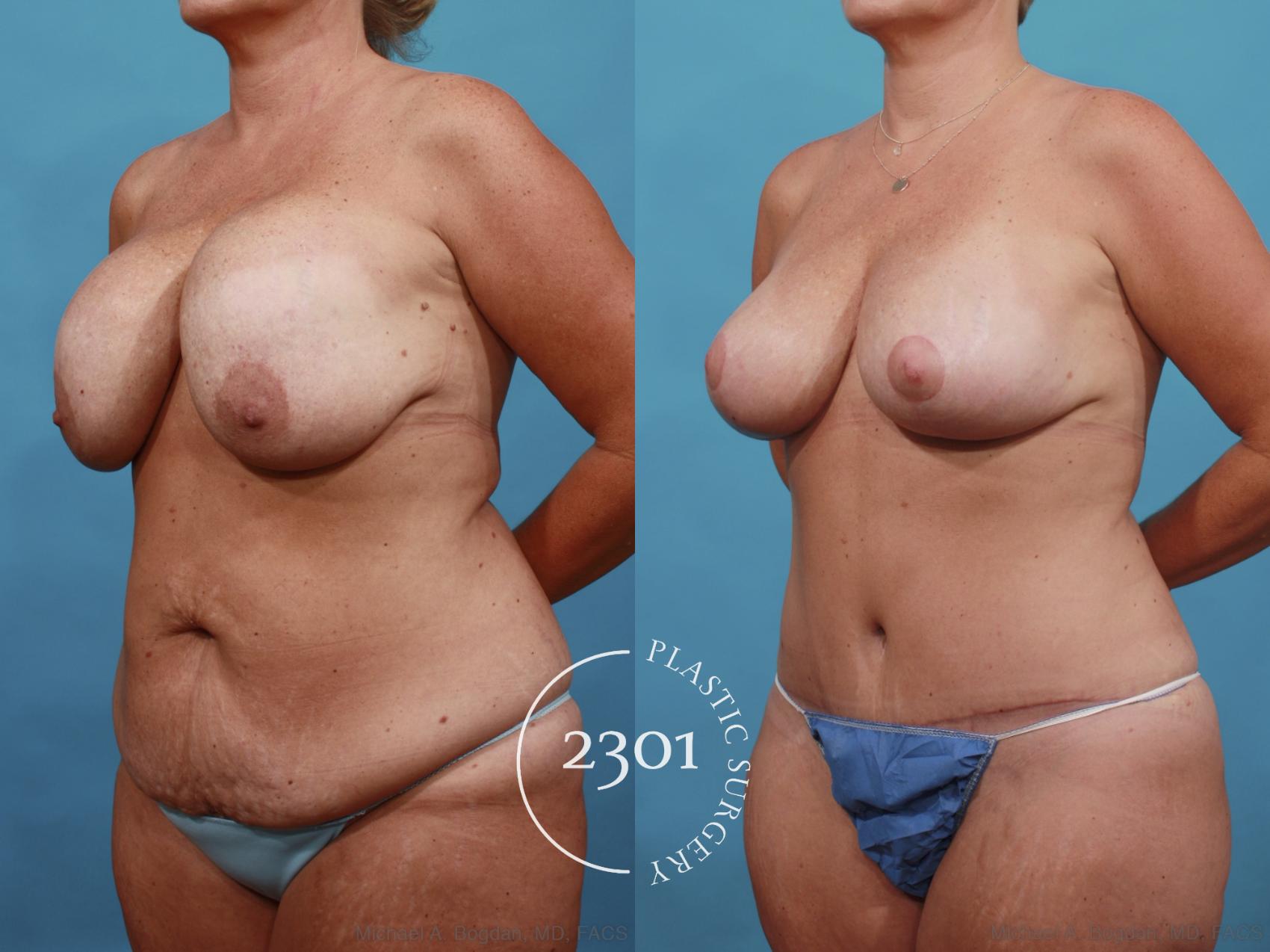 Before & After Breast Augmentation Revision Case 567 View #2 View in Fort Worth, Plano, & Frisco, Texas