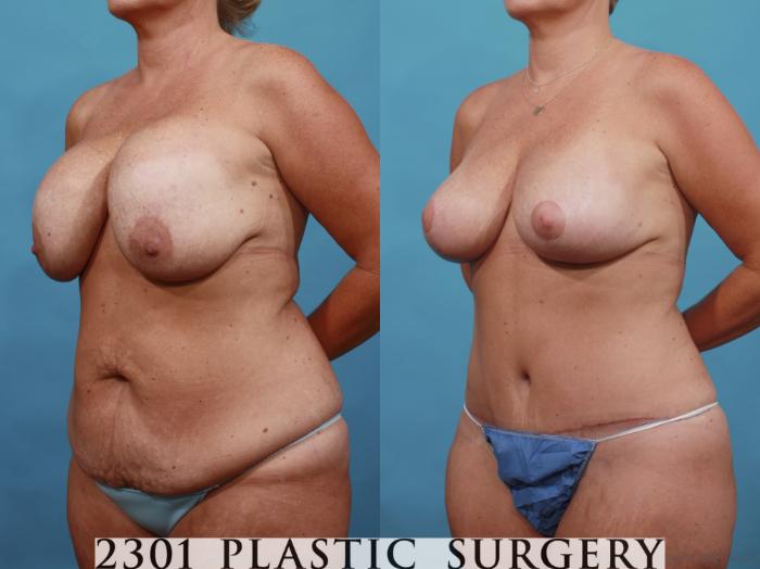 Before & After Breast Augmentation Revision Case 567 View #2 View in Fort Worth, Plano, & Frisco, Texas