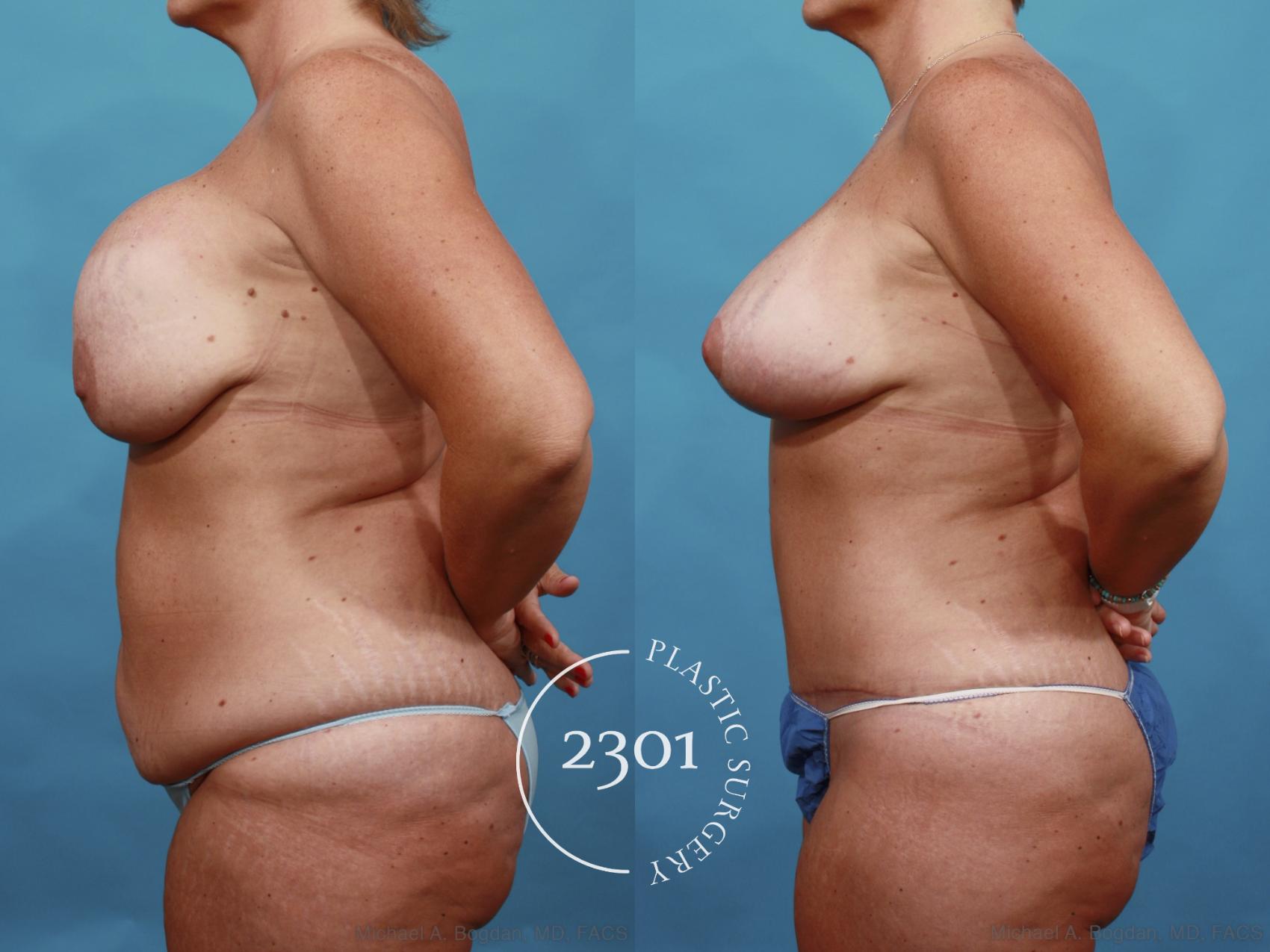 Before & After Breast Augmentation Revision Case 567 View #3 View in Fort Worth, Plano, & Frisco, Texas