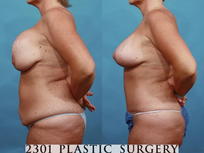 Before & After Breast Augmentation Revision Case 567 View #3 View in Fort Worth, Plano, & Frisco, Texas
