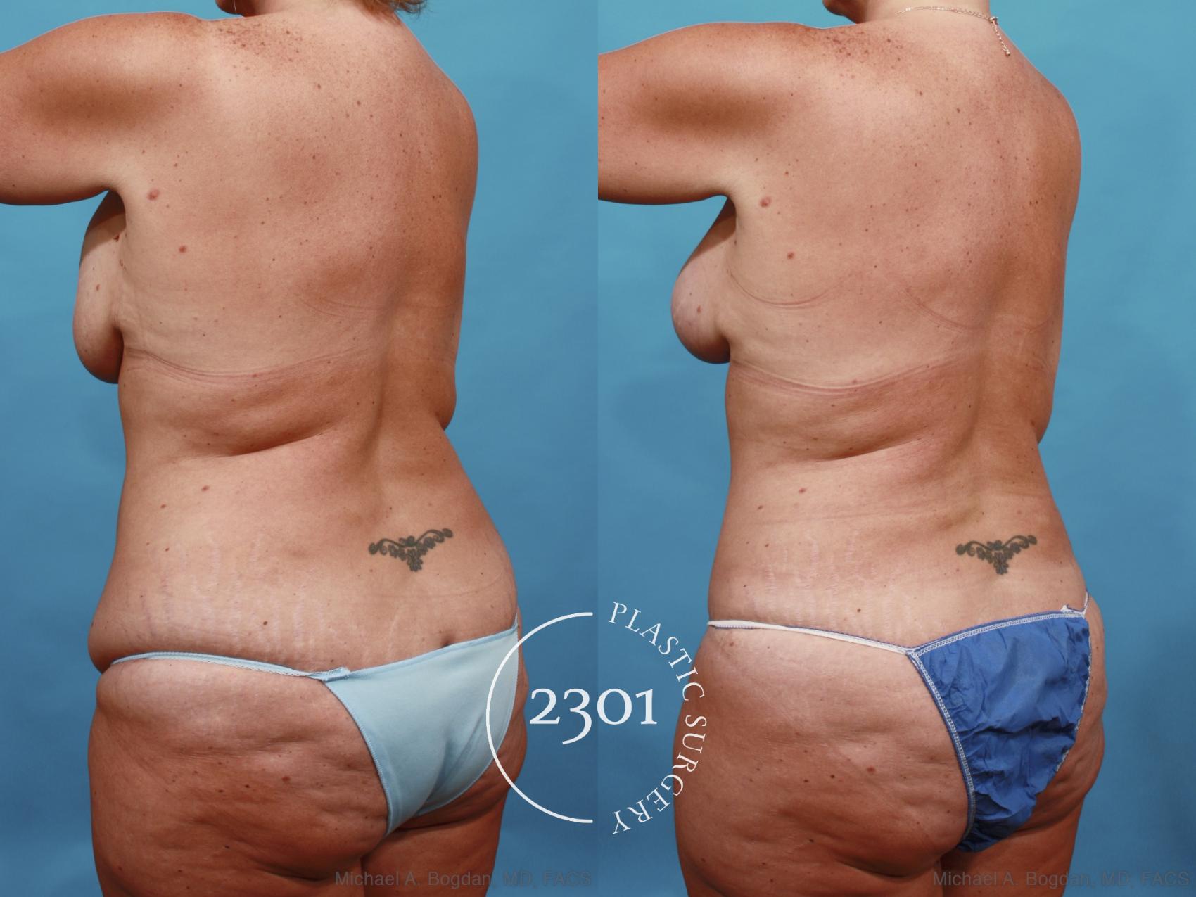 Before & After Breast Augmentation Revision Case 567 View #4 View in Fort Worth, Plano, & Frisco, Texas