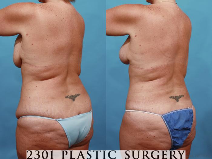Before & After Breast Augmentation Revision Case 567 View #4 View in Fort Worth, Plano, & Frisco, Texas