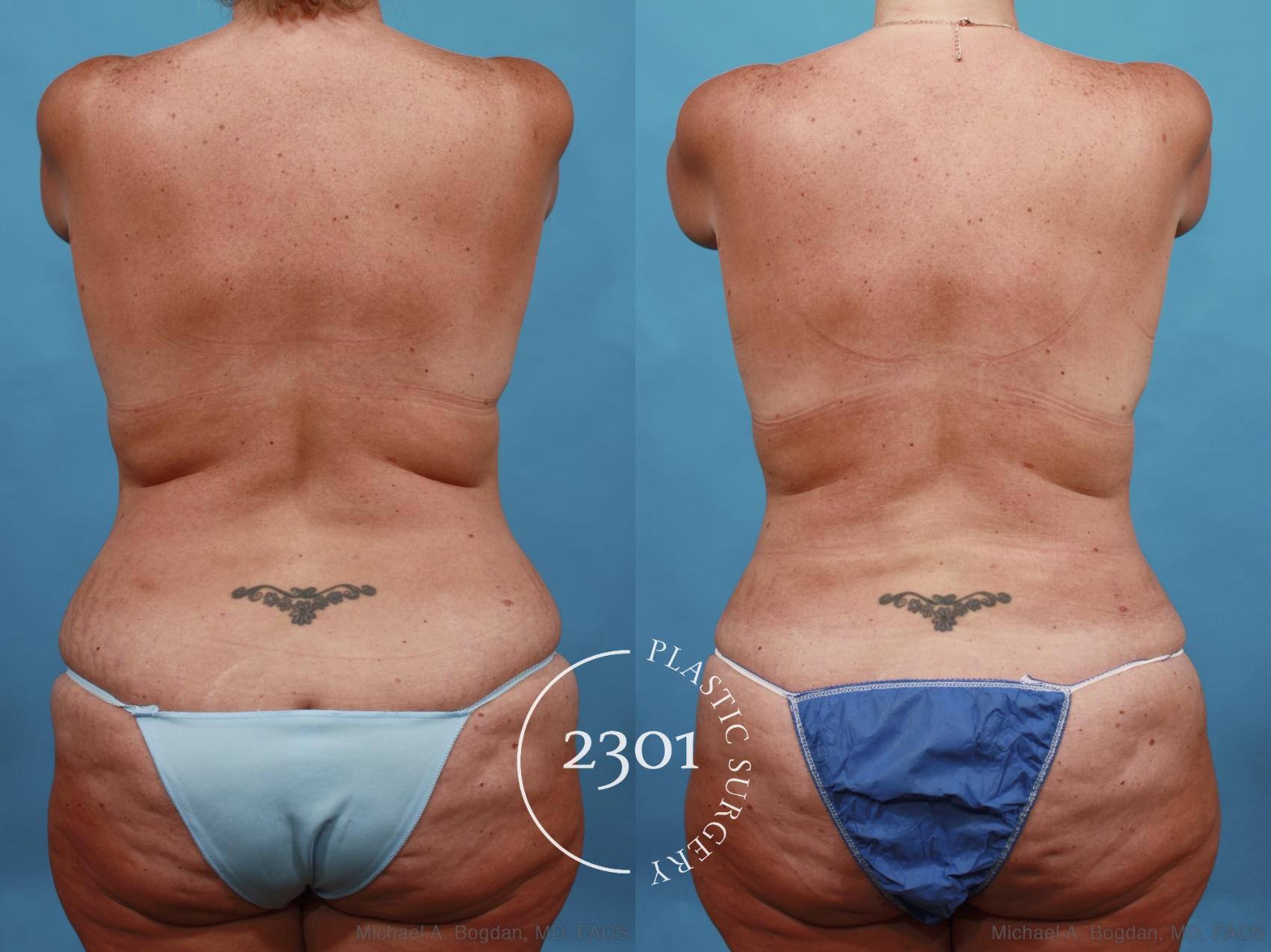 Before & After Breast Augmentation Revision Case 567 View #5 View in Fort Worth, Plano, & Frisco, Texas