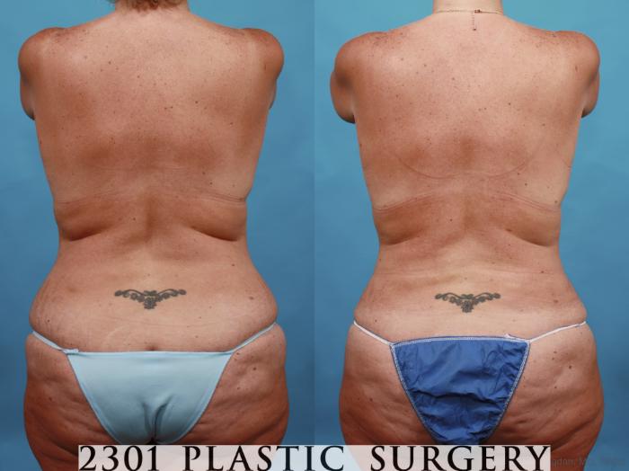 Before & After Breast Lift (Mastopexy) Case 567 View #5 View in Fort Worth, Plano, & Frisco, Texas