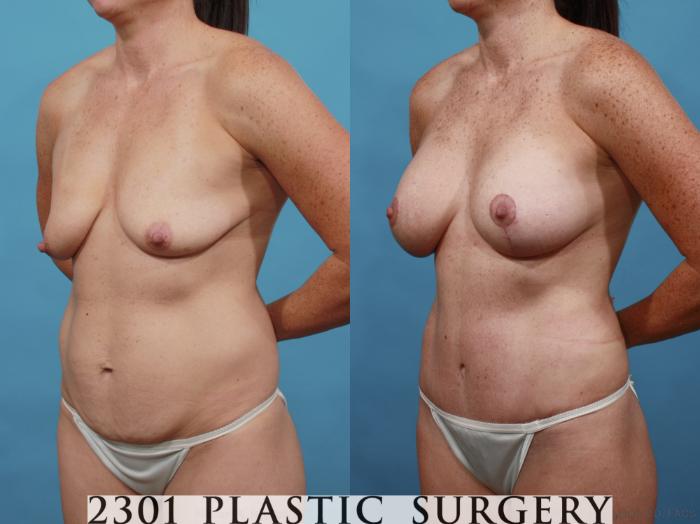 Before & After Mommy Makeover Case 568 View #2 View in Fort Worth & Frisco, Texas