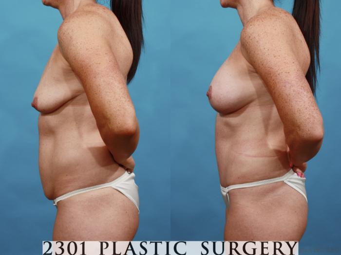 Before & After Mommy Makeover Case 568 View #3 View in Fort Worth & Frisco, Texas