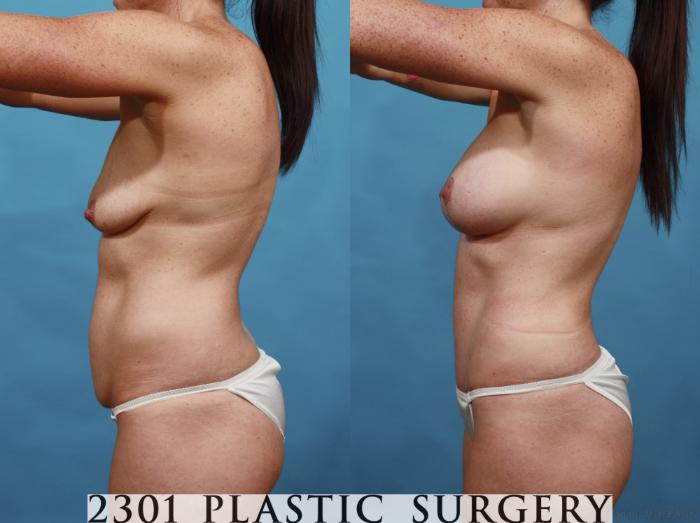 Before & After Mommy Makeover Case 568 View #4 View in Fort Worth & Frisco, Texas
