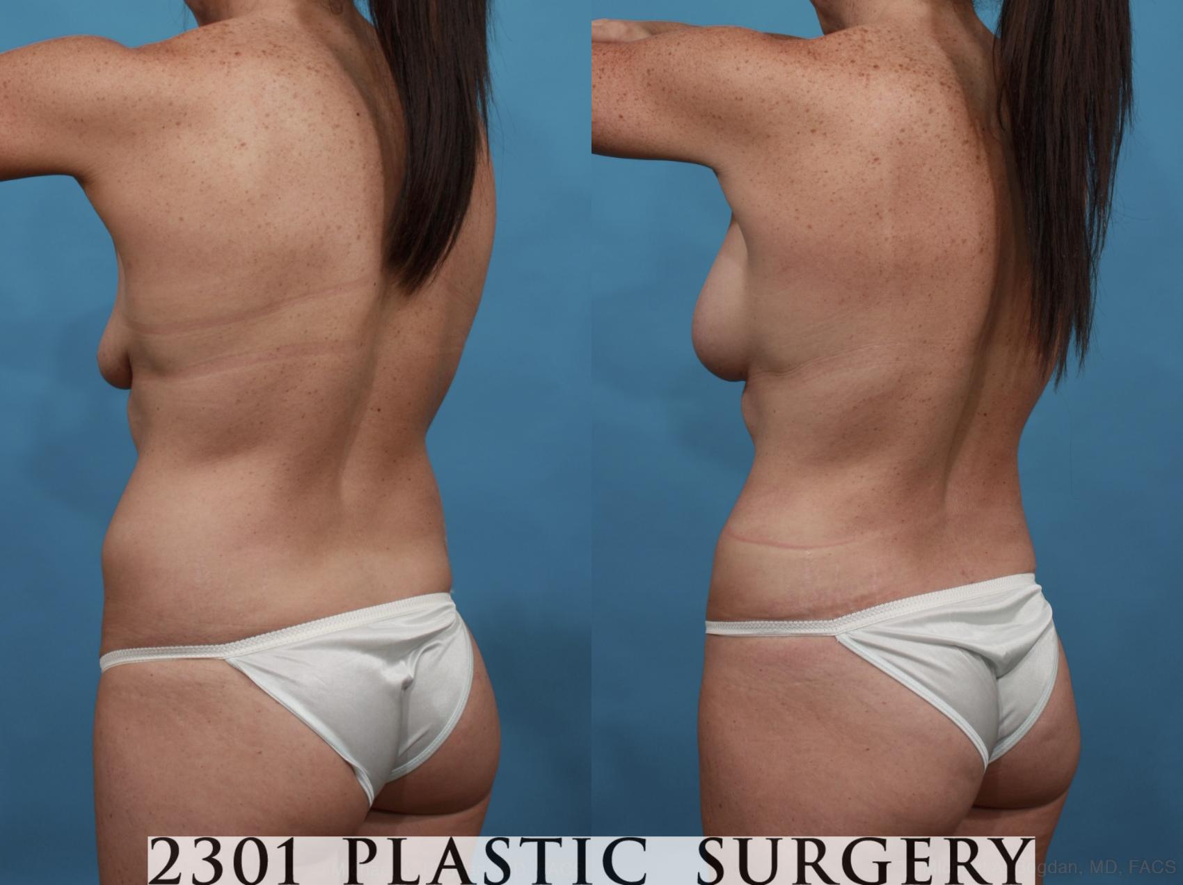 Before & After Mommy Makeover Case 568 View #5 View in Fort Worth & Frisco, Texas