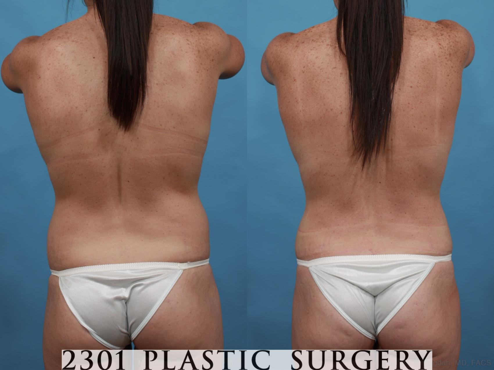Before & After Mommy Makeover Case 568 View #6 View in Fort Worth & Frisco, Texas